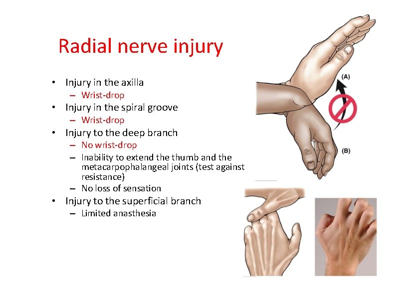 Radial nerve injury • Injury in the axilla – Wrist‐drop • Injury in the