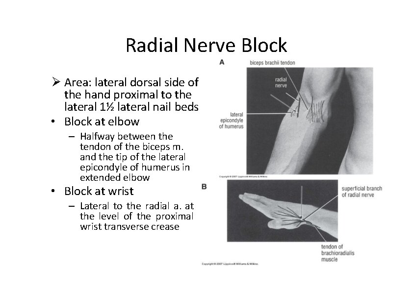 Radial Nerve Block Area: lateral dorsal side of the hand proximal to the lateral