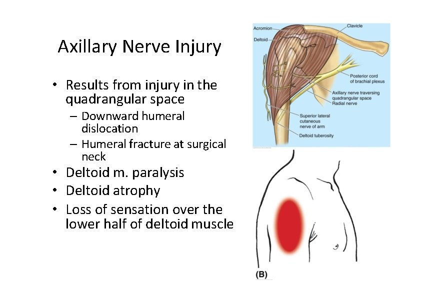 Axillary Nerve Injury • Results from injury in the quadrangular space – Downward humeral