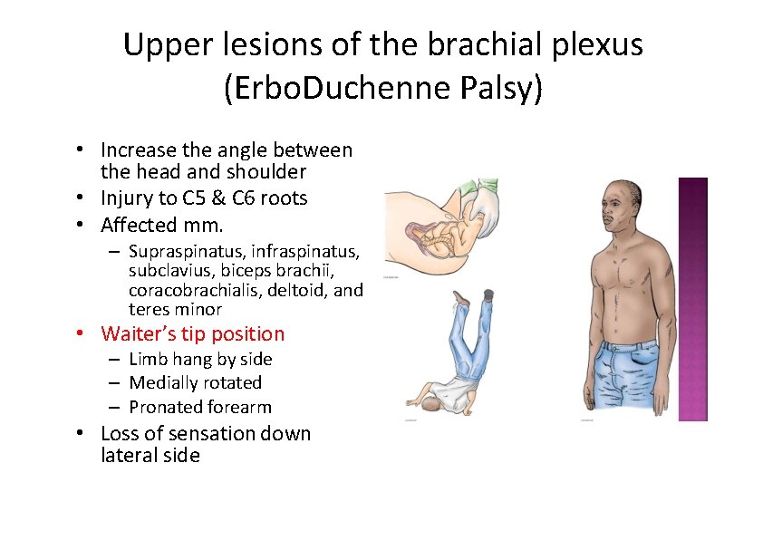 Upper lesions of the brachial plexus (Erbo. Duchenne Palsy) • Increase the angle between