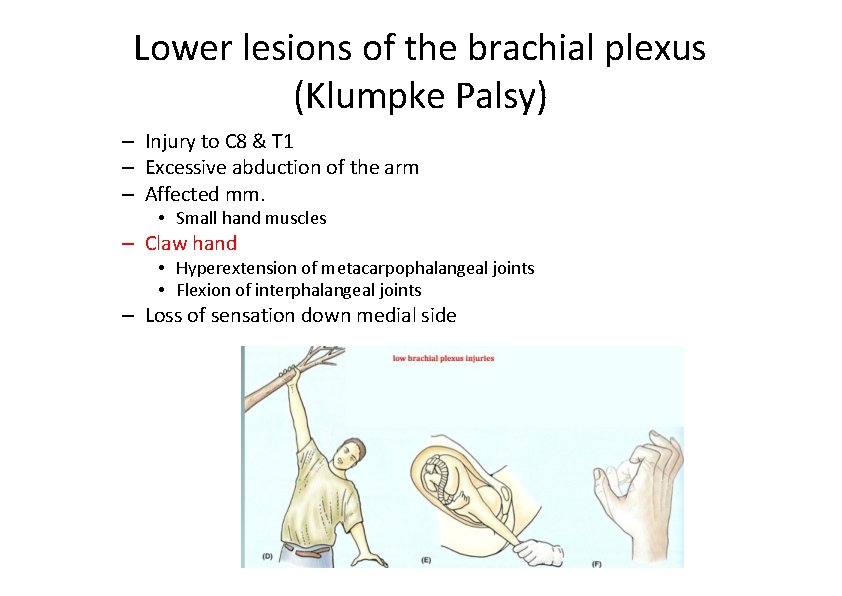 Lower lesions of the brachial plexus (Klumpke Palsy) – Injury to C 8 &