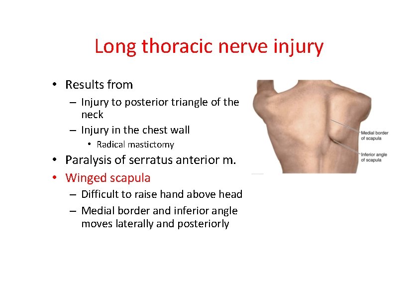 Long thoracic nerve injury • Results from – Injury to posterior triangle of the