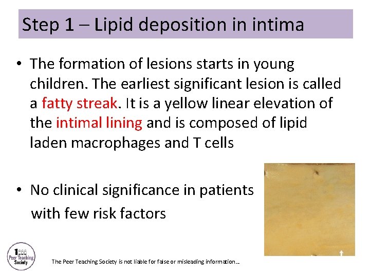 Step 1 – Lipid deposition in intima • The formation of lesions starts in