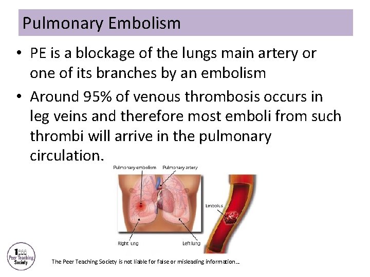 Pulmonary Embolism • PE is a blockage of the lungs main artery or one