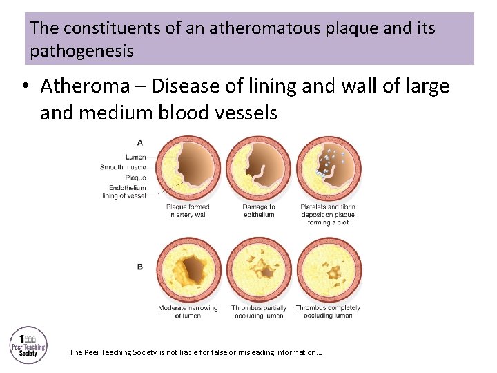 The constituents of an atheromatous plaque and its pathogenesis • Atheroma – Disease of