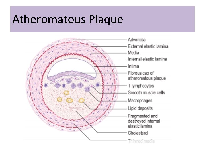 Atheromatous Plaque 