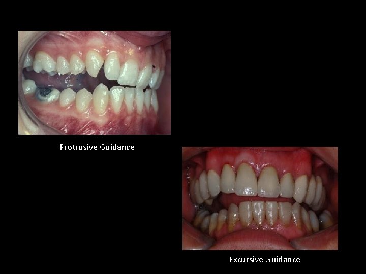 Protrusive Guidance Excursive Guidance 