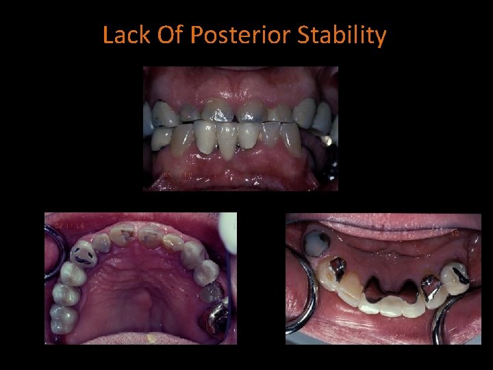 Lack Of Posterior Stability 