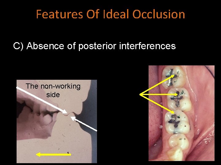 Features Of Ideal Occlusion C) Absence of posterior interferences The non-working side 