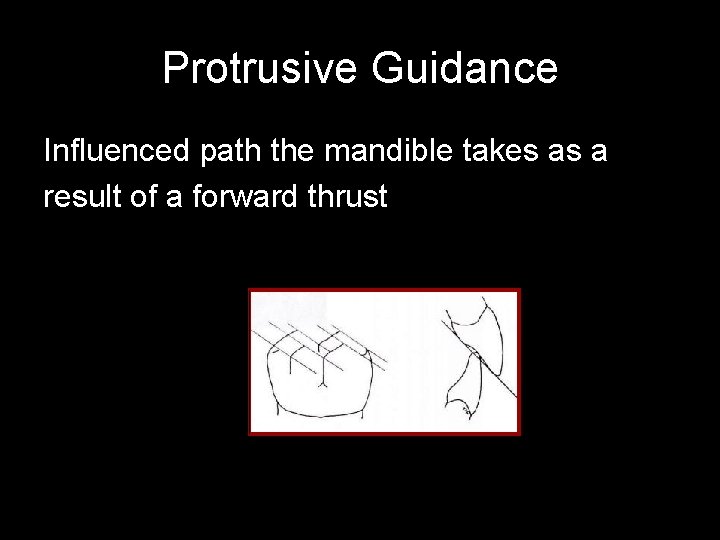 Protrusive Guidance Influenced path the mandible takes as a result of a forward thrust