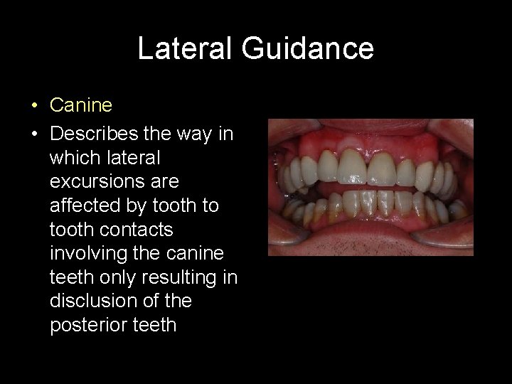 Lateral Guidance • Canine • Describes the way in which lateral excursions are affected