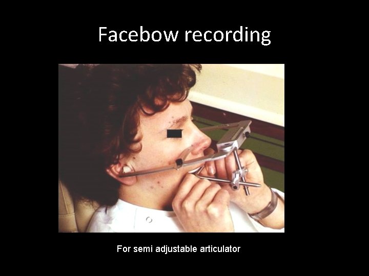 Facebow recording For semi adjustable articulator 
