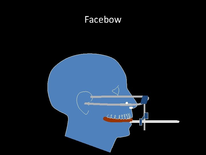 Facebow 