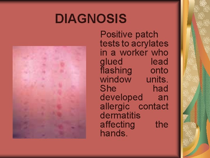 DIAGNOSIS Positive patch tests to acrylates in a worker who glued lead flashing onto