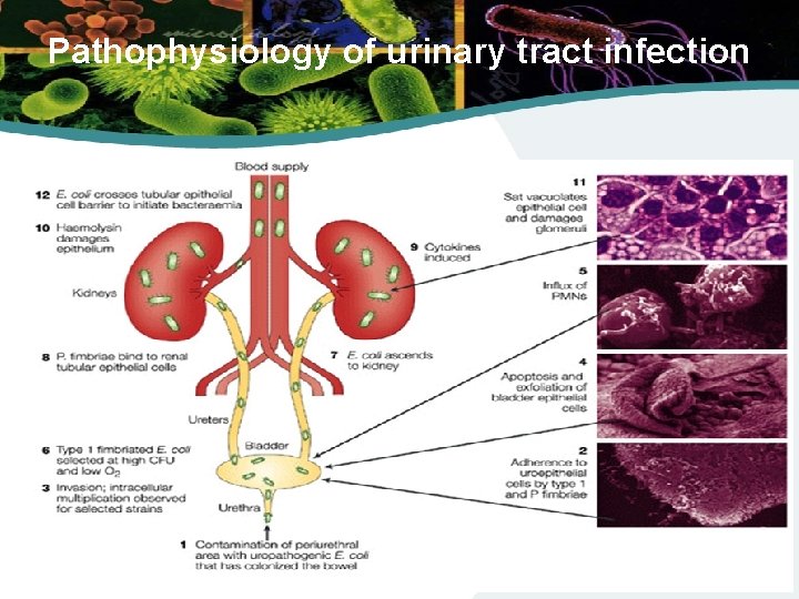 Pathophysiology of urinary tract infection 