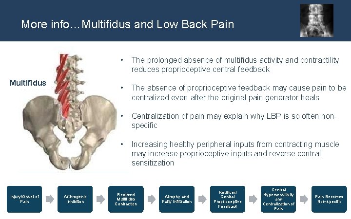 More info…Multifidus and Low Back Pain Multifidus Injury/Onset of Pain Arthrogenic Inhibition • The