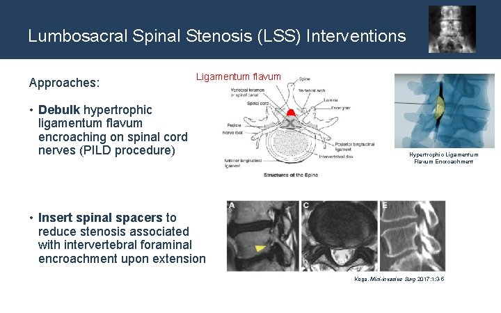 Lumbosacral Spinal Stenosis (LSS) Interventions Approaches: Ligamentum flavum • Debulk hypertrophic ligamentum flavum encroaching