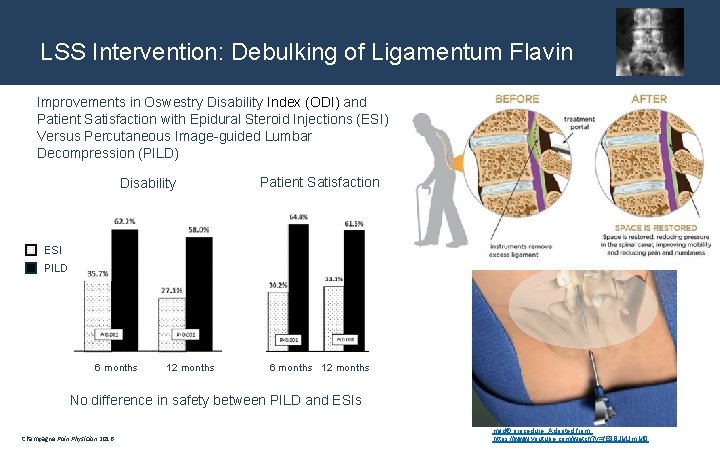 LSS Intervention: Debulking of Ligamentum Flavin Improvements in Oswestry Disability Index (ODI) and Patient
