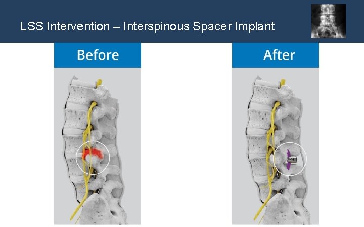 LSS Intervention – Interspinous Spacer Implant spacer 