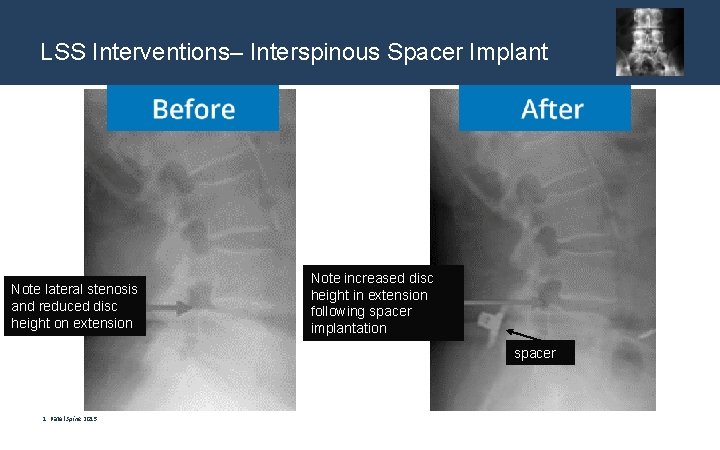 LSS Interventions– Interspinous Spacer Implant Note lateral stenosis and reduced disc height on extension