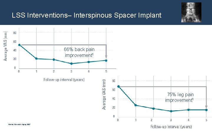 LSS Interventions– Interspinous Spacer Implant 66% back pain improvement 1 75% leg pain improvement