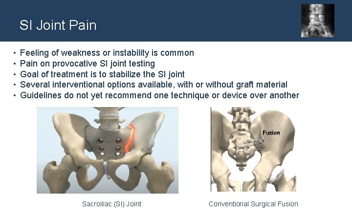 SI Joint Pain • • • Feeling of weakness or instability is common Pain