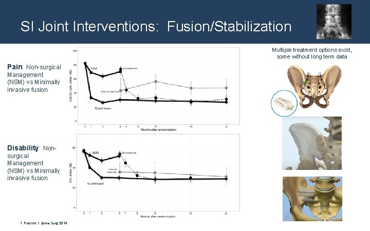 SI Joint Interventions: Fusion/Stabilization Multiple treatment options exist, some without long term data Pain: