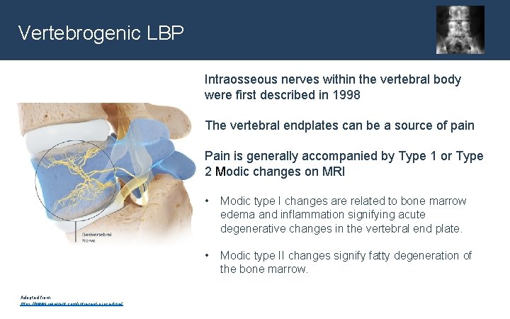 Vertebrogenic LBP Intraosseous nerves within the vertebral body were first described in 1998 The