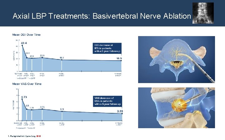 Axial LBP Treatments: Basivertebral Nerve Ablation 1. Fischgrund Int J Spine Surg 2020 
