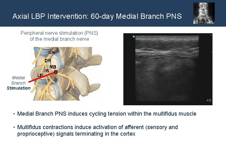 Axial LBP Intervention: 60 -day Medial Branch PNS Peripheral nerve stimulation (PNS) of the