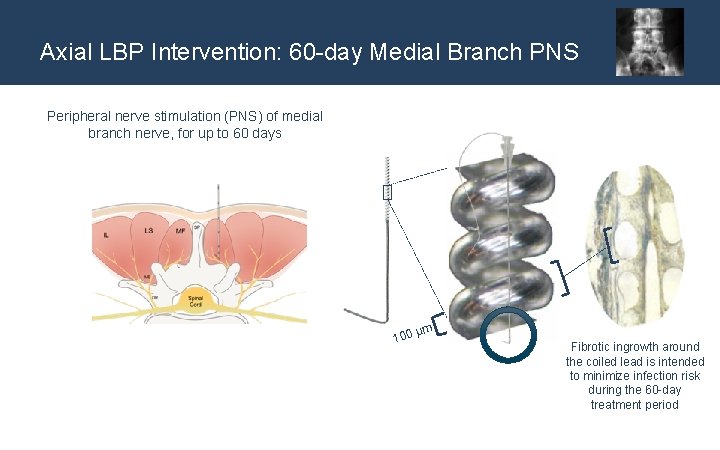 Axial LBP Intervention: 60 -day Medial Branch PNS Peripheral nerve stimulation (PNS) of medial