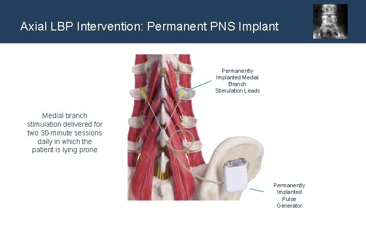 Axial LBP Intervention: Permanent PNS Implant Permanently Implanted Medial Branch Stimulation Leads Medial branch