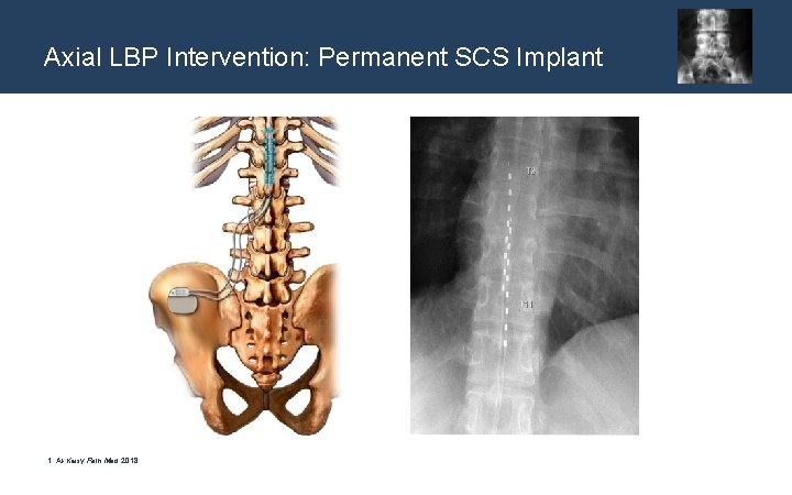 Axial LBP Intervention: Permanent SCS Implant 1. Al-Kaisy Pain Med 2018 
