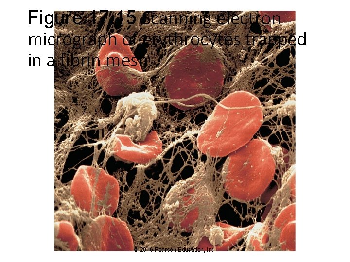 Figure 17. 15 Scanning electron micrograph of erythrocytes trapped in a fibrin mesh. ©