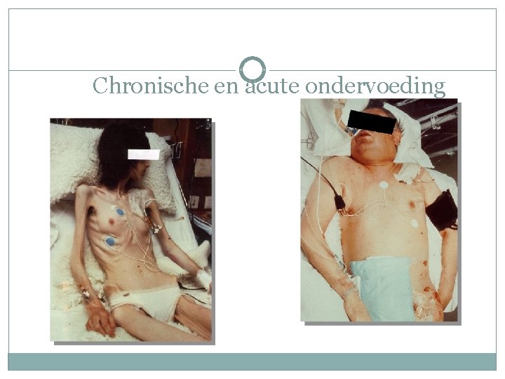 Chronische en acute ondervoeding 