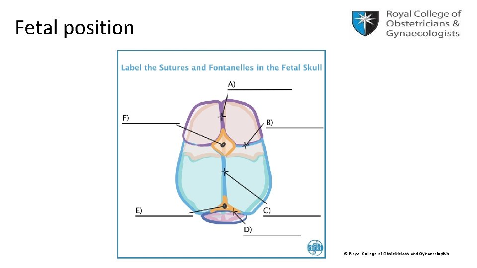 Fetal position © Royal College of Obstetricians and Gynaecologists 