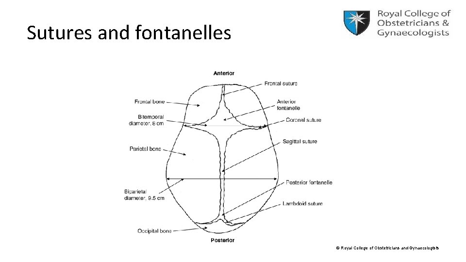 Sutures and fontanelles © Royal College of Obstetricians and Gynaecologists 