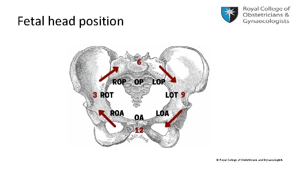 Fetal head position © Royal College of Obstetricians and Gynaecologists 