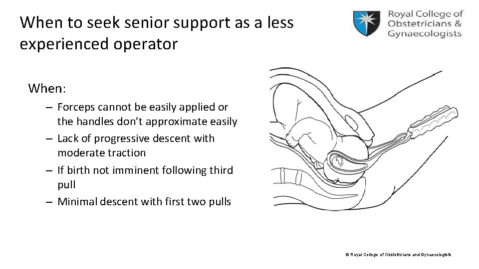 When to seek senior support as a less experienced operator When: – Forceps cannot