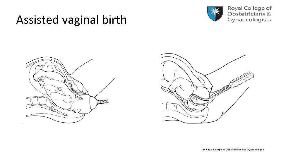 Assisted vaginal birth © Royal College of Obstetricians and Gynaecologists 