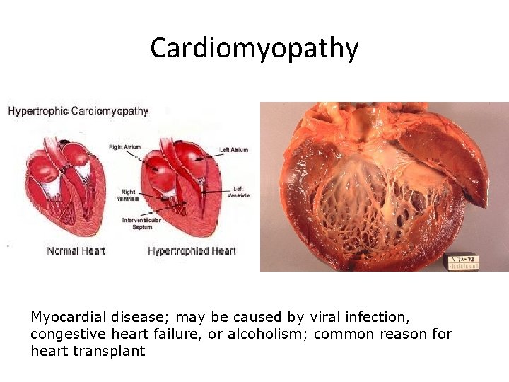 Cardiomyopathy Myocardial disease; may be caused by viral infection, congestive heart failure, or alcoholism;