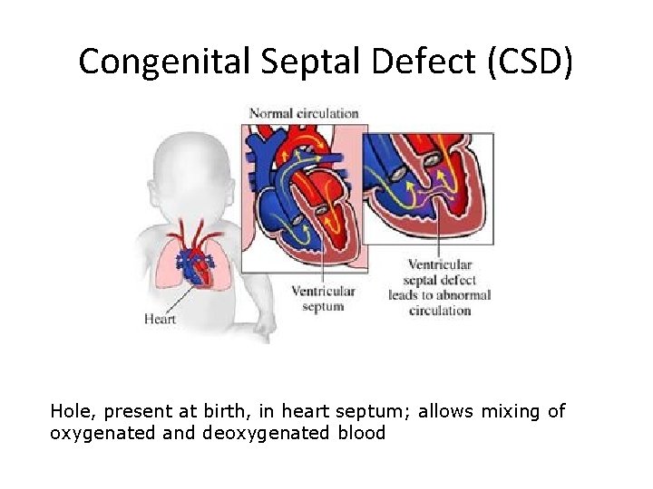 Congenital Septal Defect (CSD) Hole, present at birth, in heart septum; allows mixing of