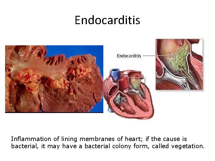 Endocarditis Inflammation of lining membranes of heart; if the cause is bacterial, it may