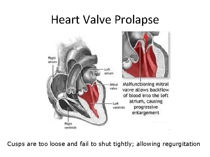 Heart Valve Prolapse Cusps are too loose and fail to shut tightly; allowing regurgitation