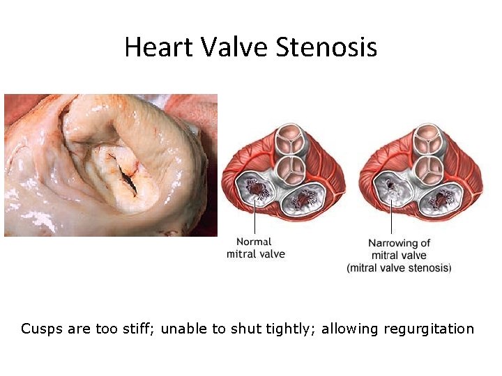 Heart Valve Stenosis Cusps are too stiff; unable to shut tightly; allowing regurgitation 