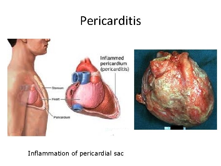 Pericarditis Inflammation of pericardial sac 