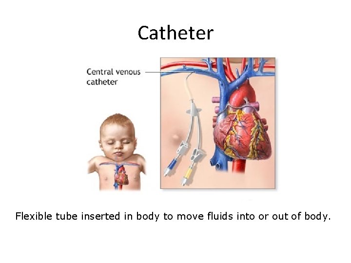 Catheter Flexible tube inserted in body to move fluids into or out of body.