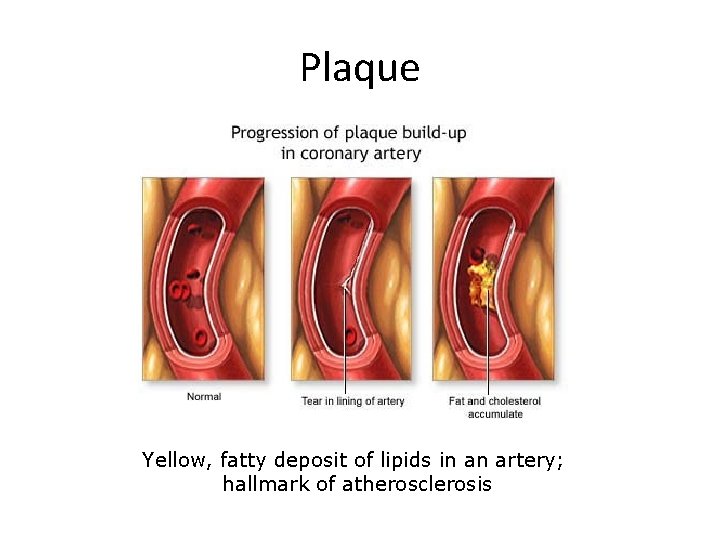 Plaque Yellow, fatty deposit of lipids in an artery; hallmark of atherosclerosis 