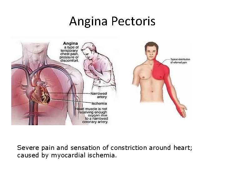 Angina Pectoris Severe pain and sensation of constriction around heart; caused by myocardial ischemia.