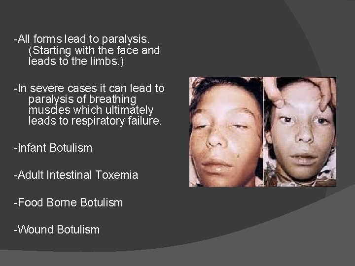 -All forms lead to paralysis. (Starting with the face and leads to the limbs.